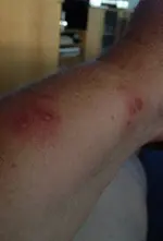 Pastinaken allergie.webp